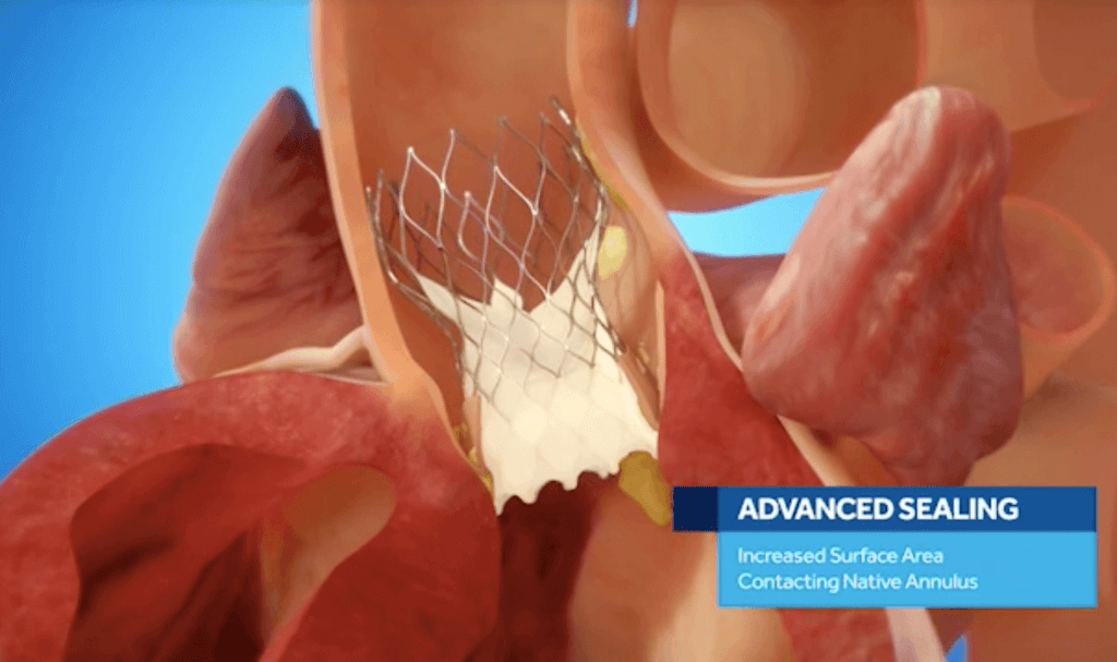 Transcatheter Aortic Valve Replacement Singing River Health System