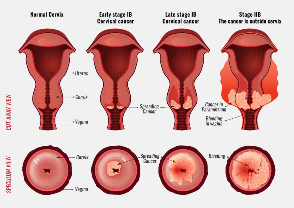 Cervical cancer development image. Detailed vector illustration with uterus and cervix carcinoma stages. Biology, anatomy, medicine, physiology and healthcare scientific concept.