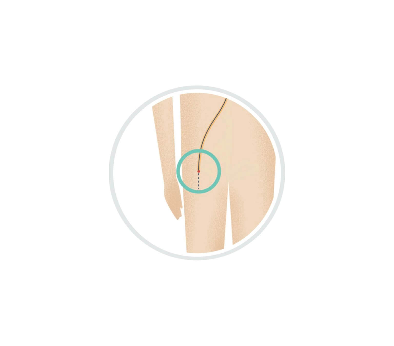 WATCHMAN FLX Pro AFib Implant - Cardiac Care | Singing River Health System