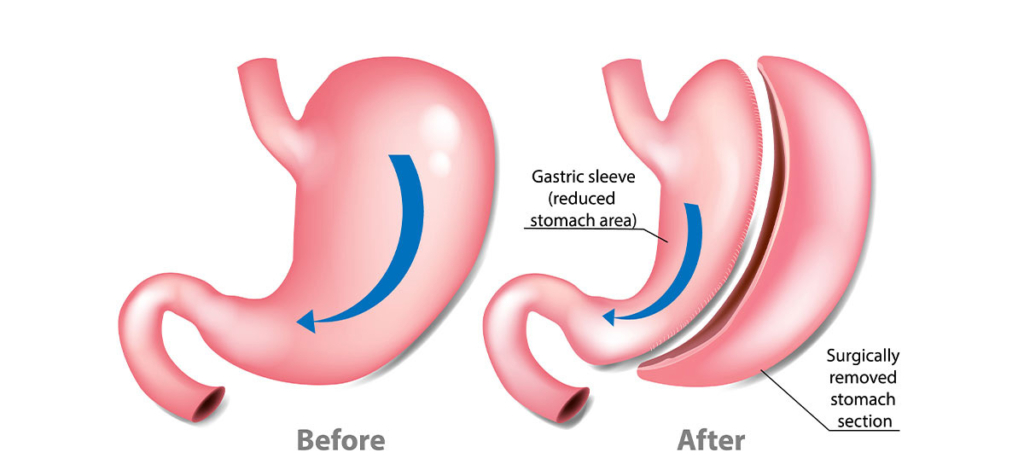 Gastric sleeve weight loss surgery 