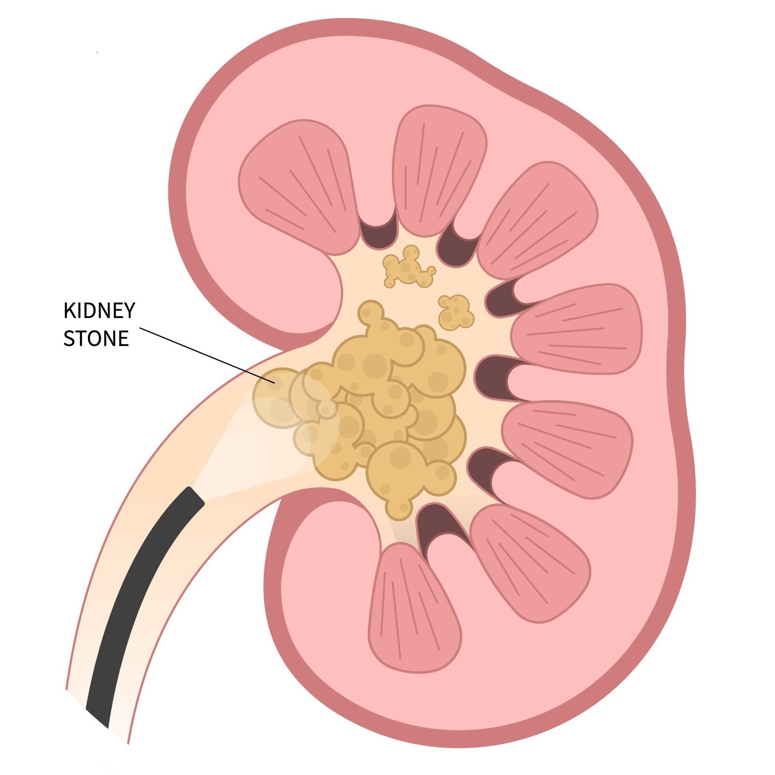 Kidney Stones - Non-Surgical & Surgical Treatment | Singing River ...