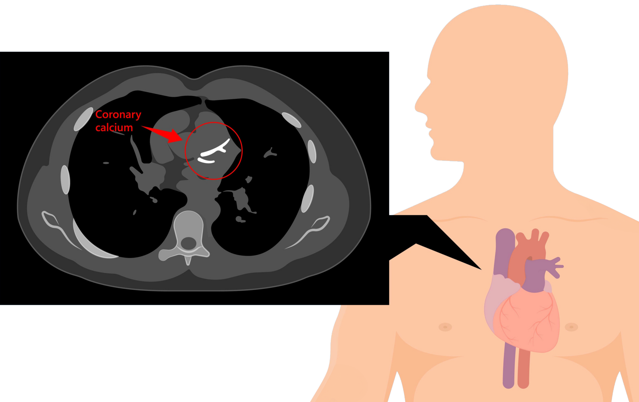 Cardiac CT for Calcium Scoring - Heart Testing | Singing River Health ...